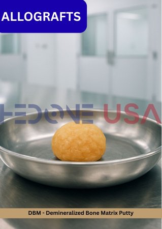 DBM - Demineralized Bone Matrix Putty
