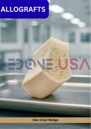 Iliac Crest Wedge